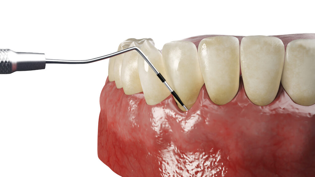 3d rendered illustration of periodontitis testing
